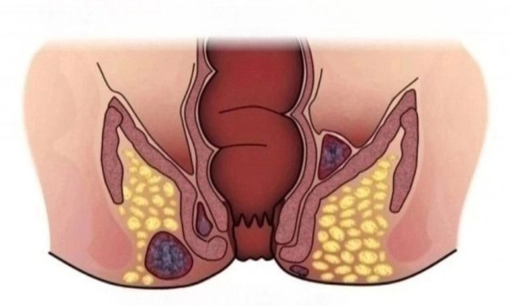 perianal abse