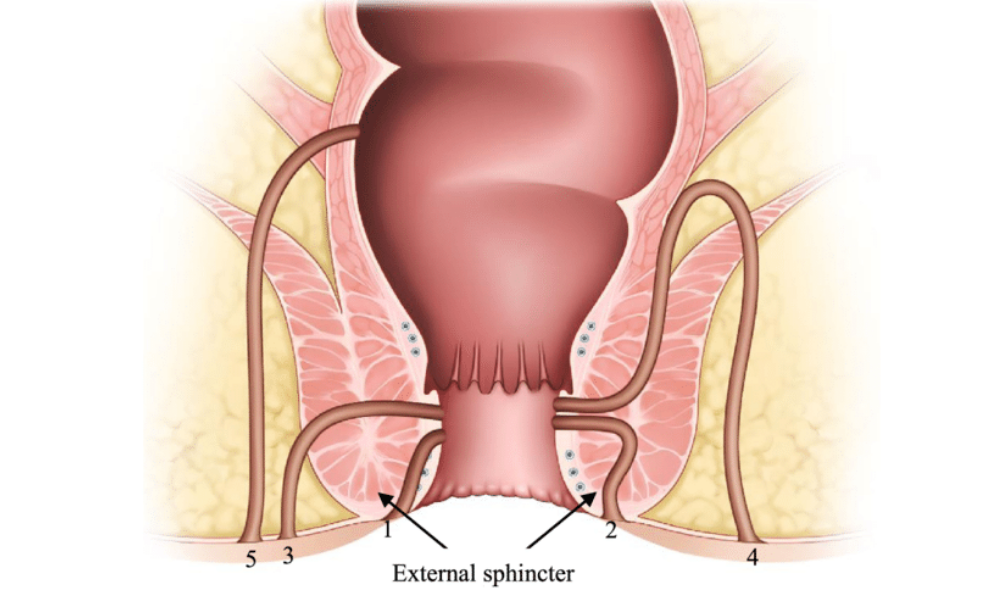 perianal-fistuller