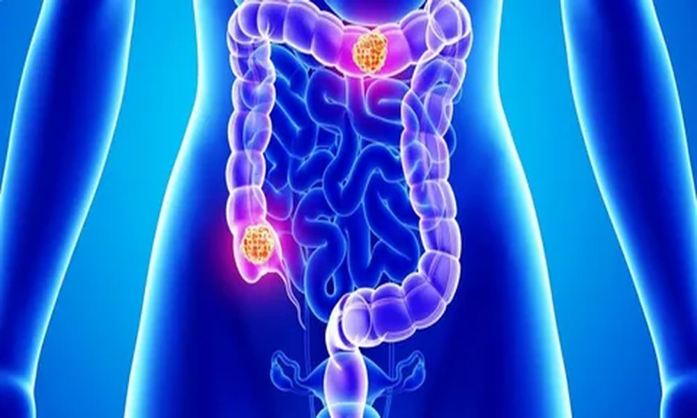 Лечение рака толстой кишки