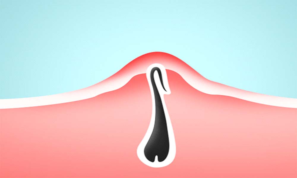 Хирургия вросших волос