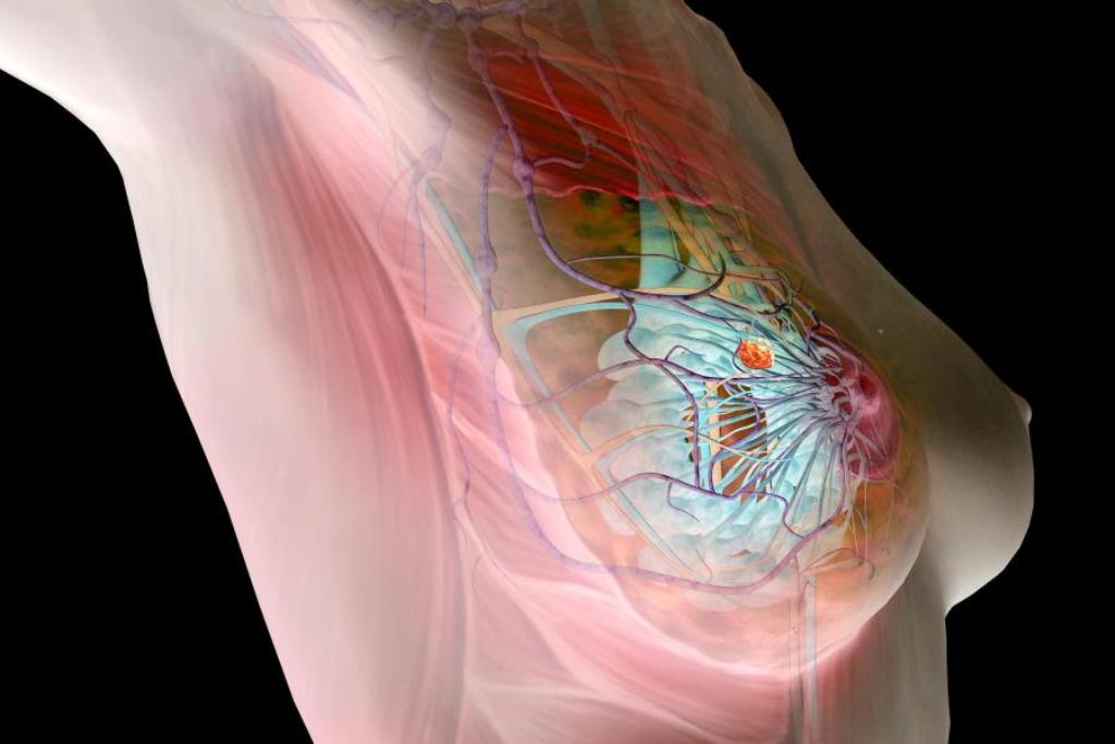 Рак молочной железы