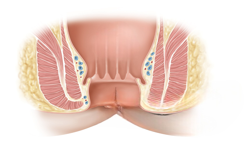 Хирургия перианальной фистулы