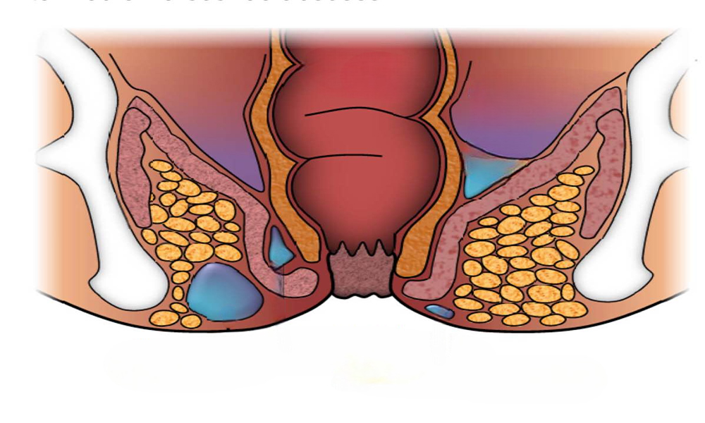 Хирургия перианальной фистулы