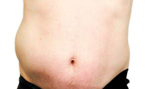 Karın Duvarı Fıtığı Tedavisi