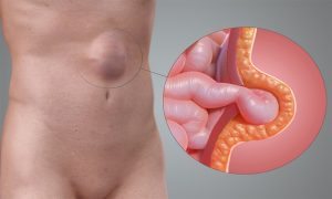 Diafragma Hernisi Nedir?