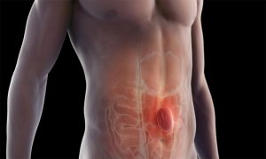 Diafragma Hernisi Nedir?